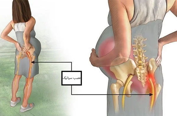 درمان سیاتیک در بارداری