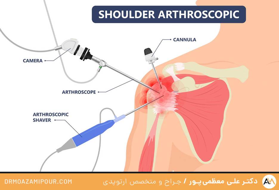 ترمیم کلاهک گرداننده با آرتروسکوپی