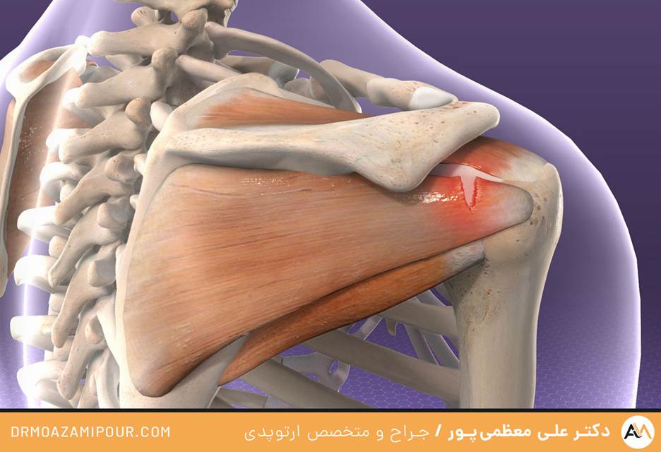 ترمیم کلاهک گرداننده