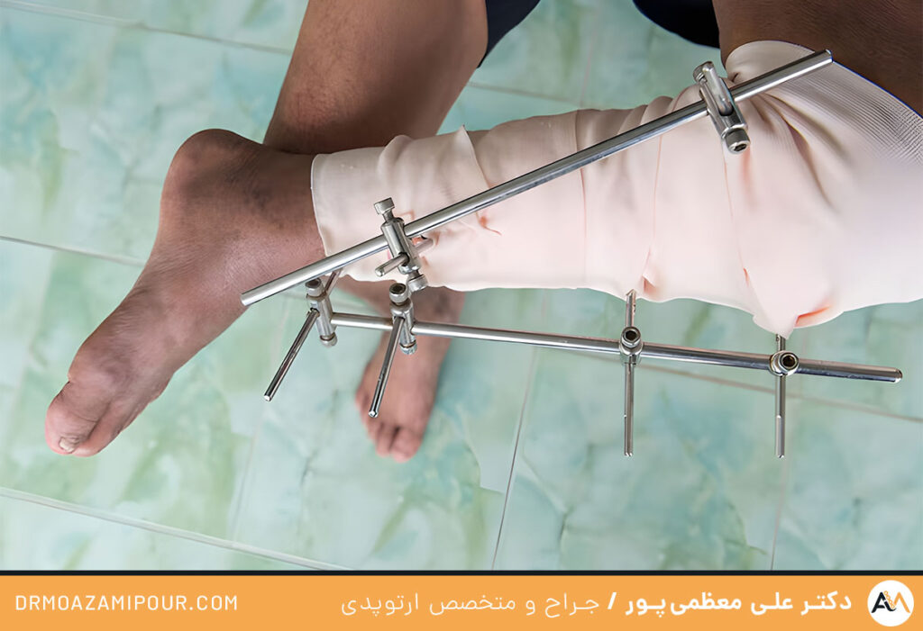 پلاتین در پا