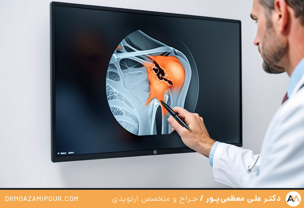  علائم پارگی روتاتور کاف