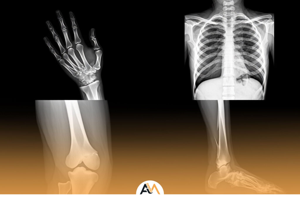 نشانه های جوش خوردن استخوان