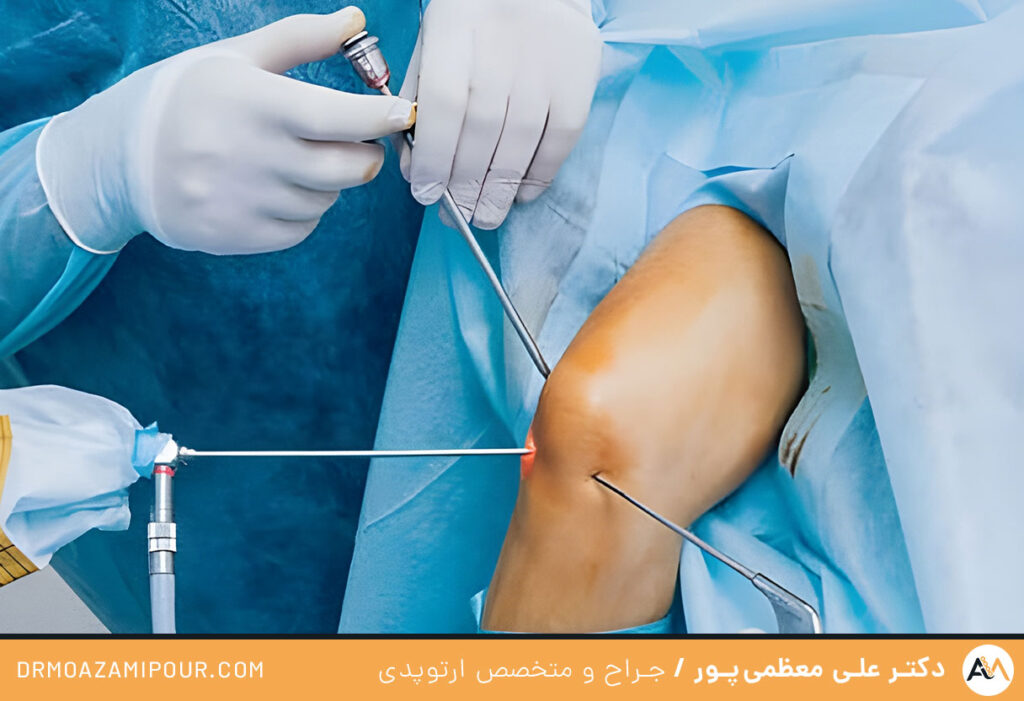 پروتز رباط صلیبی