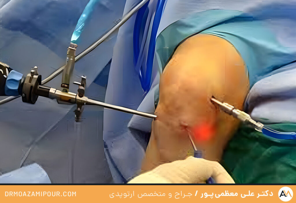 پروتز کردن رباط صلیبی