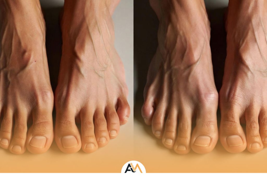 عمل کوتاهی انگشت پا