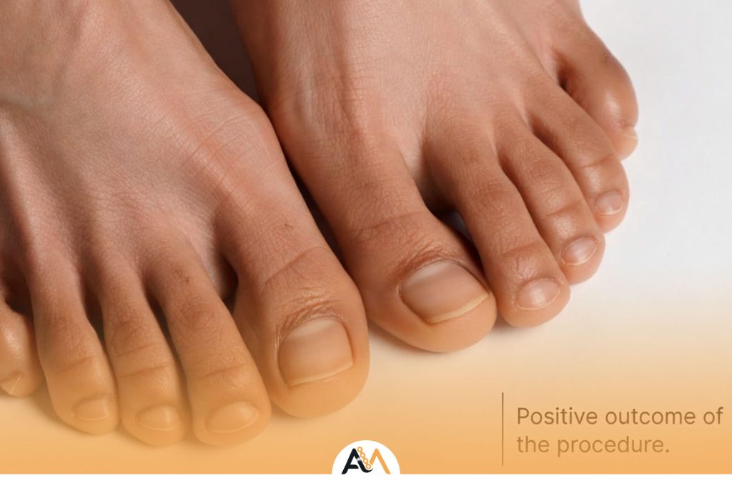 عمل کوتاهی انگشت چهارم پا