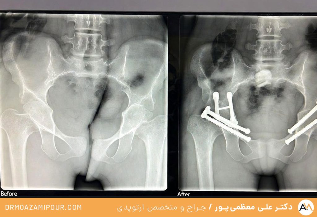  عمل شکستگی لگن