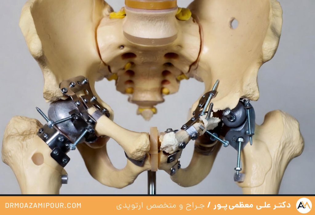 عمل شکستگی لگن در قم