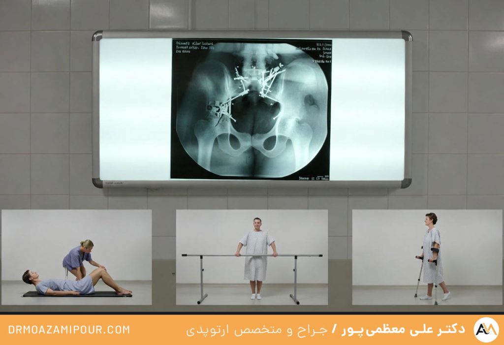 جراحی شکستگی باسن