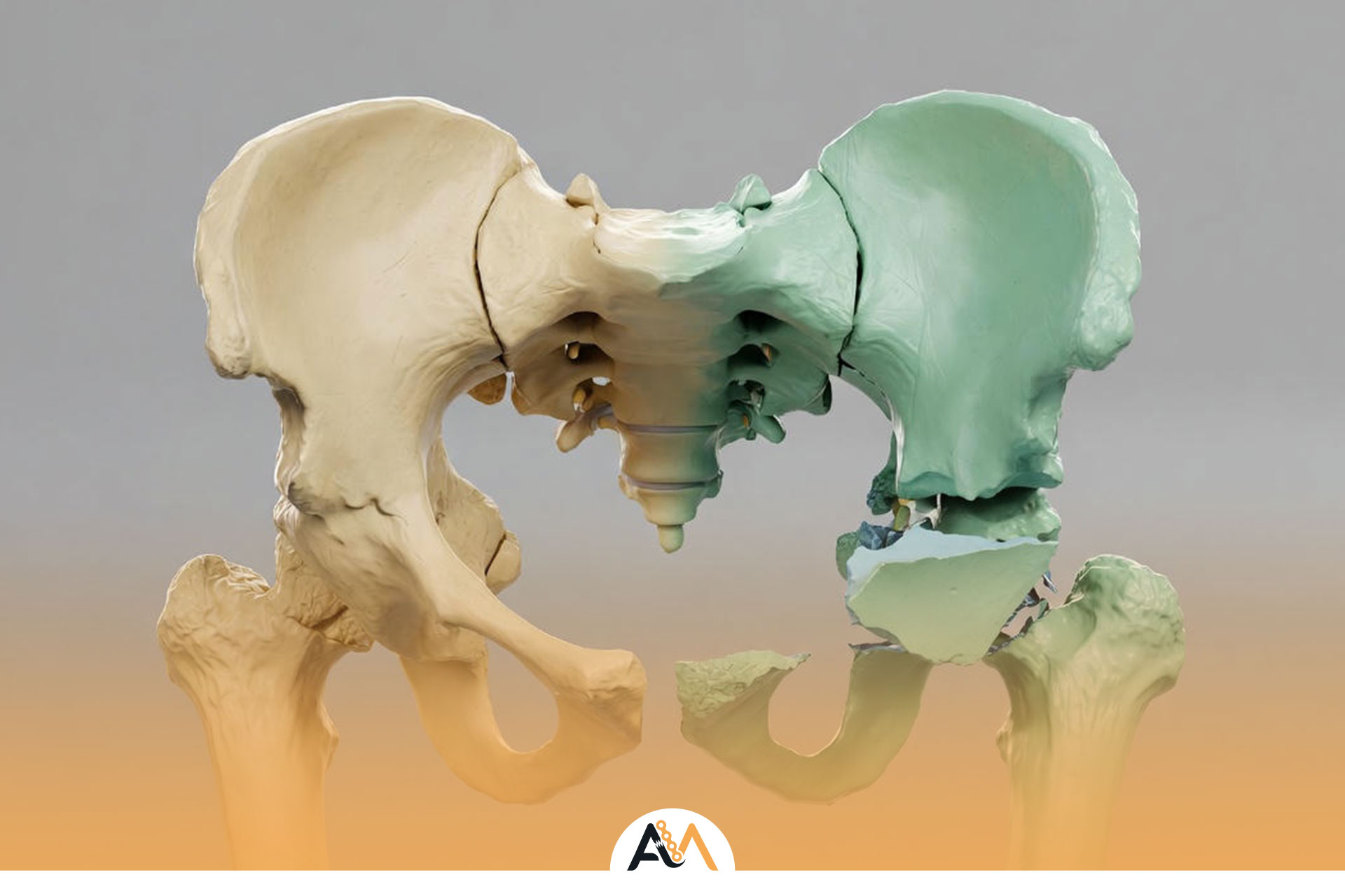 جراحی شکستگی لگن