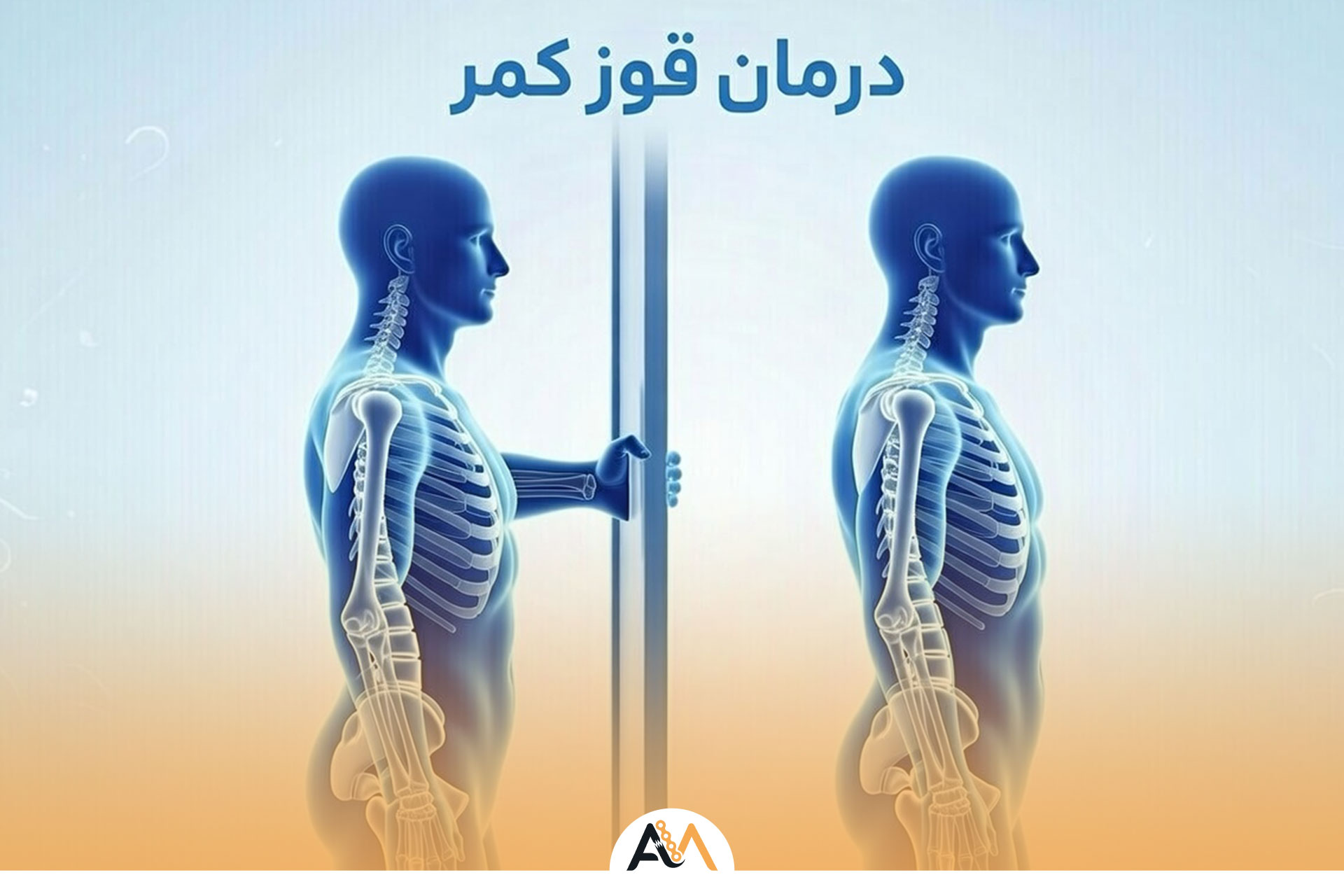 درمان قوز کمر