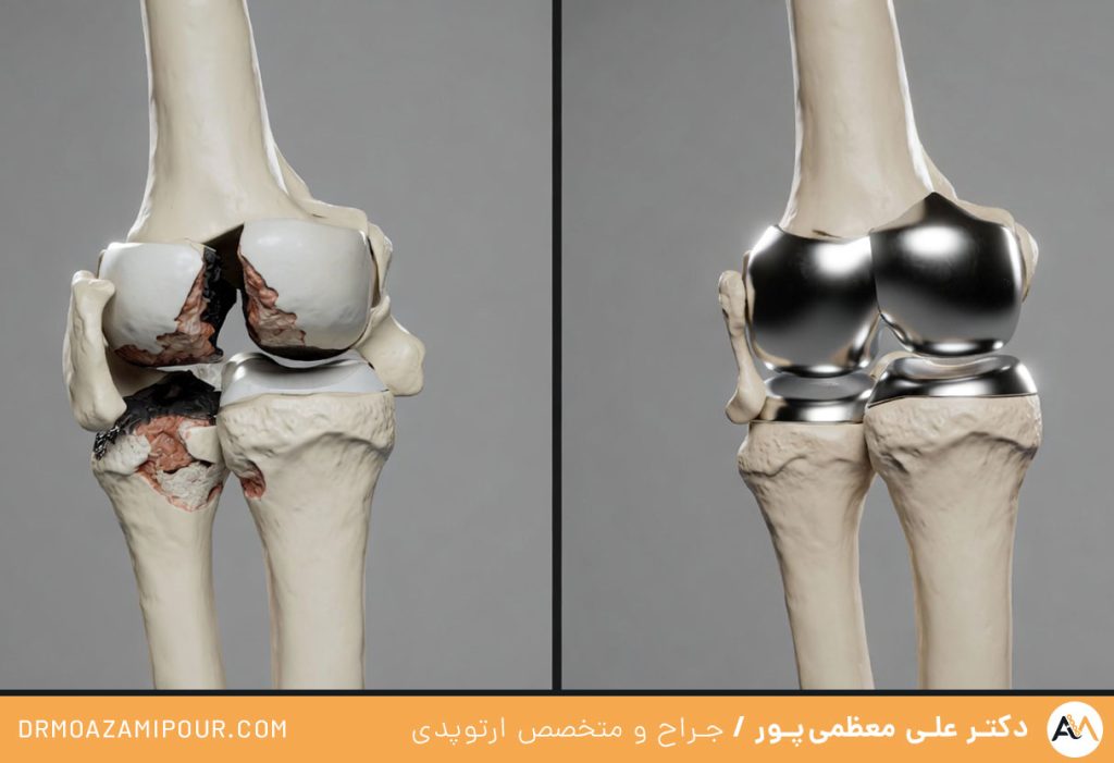آرتروپلاستی آرنج در قم