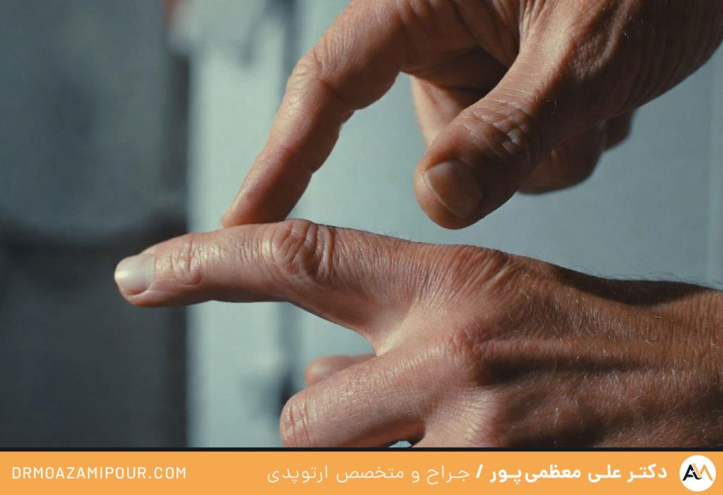 ورزش برای انگشت ماشه ای