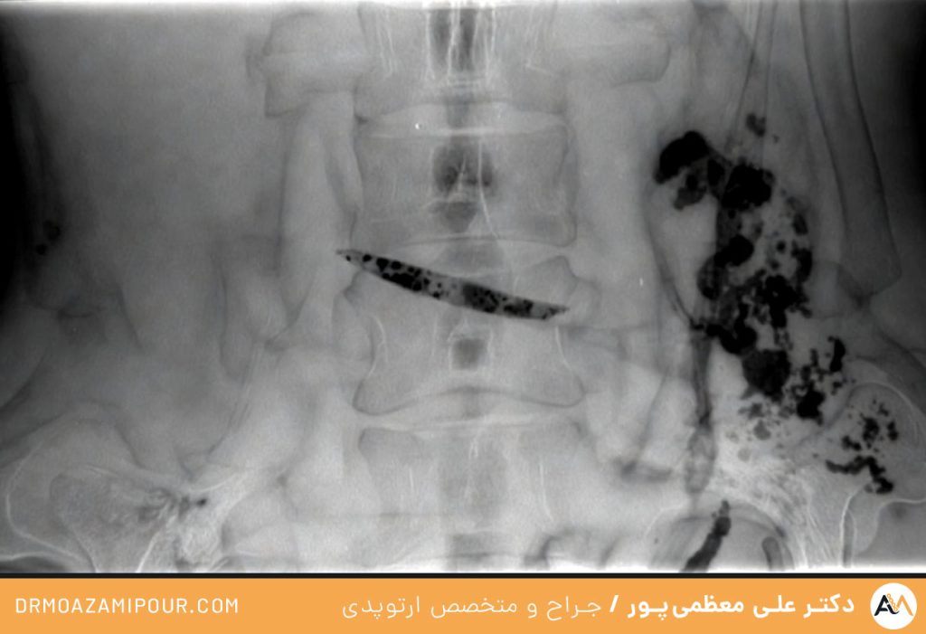 روش‌های تشخیص و درمان شکستگی ساکروم