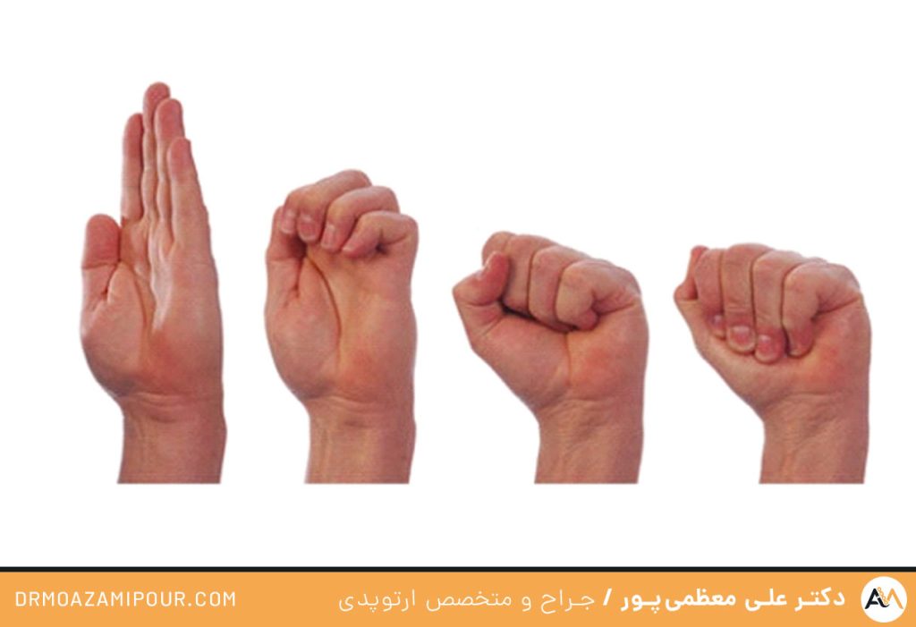 ورزش برای انگشت شست ماشه ای