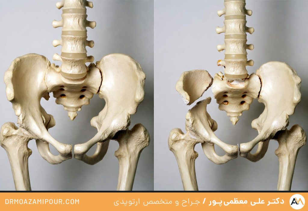 علایم شکستگی ساکروم
