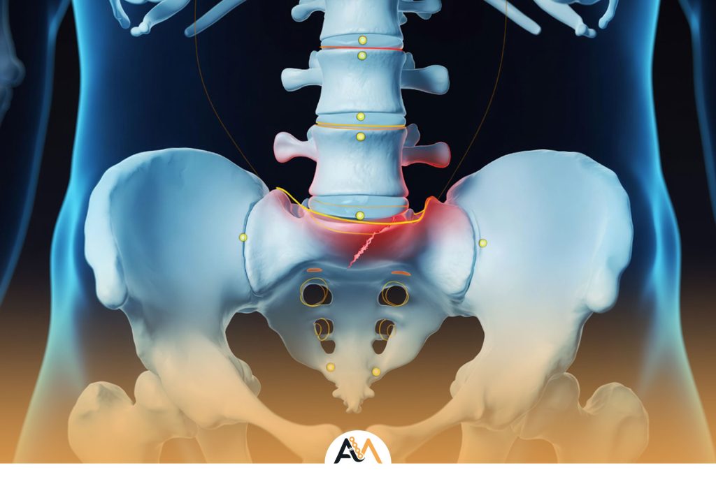 شکستگی ساکروم