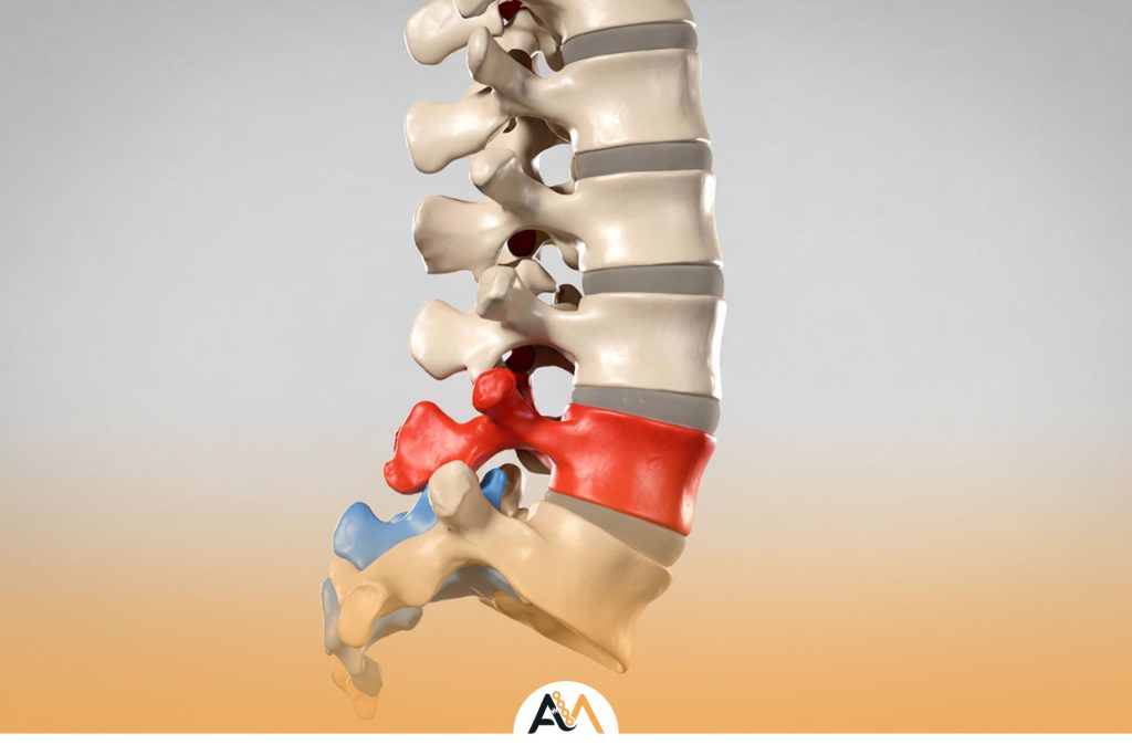 درمان شکستگی ساکروم