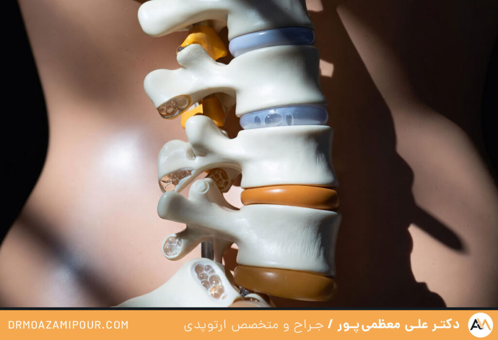 شکستن قولنج کمر