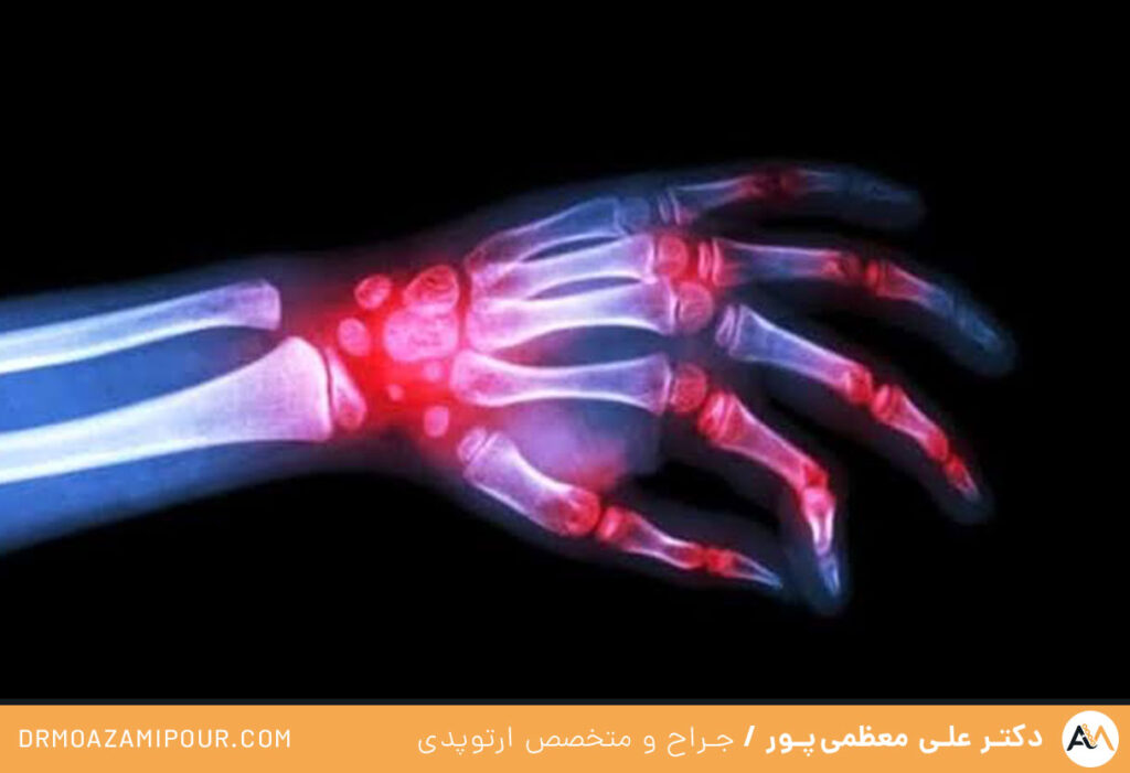 شکستن قولنج انگشتان دست