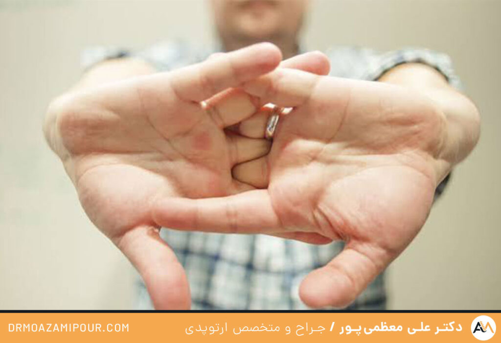 عوارض شکستن قولنج انگشتان دست