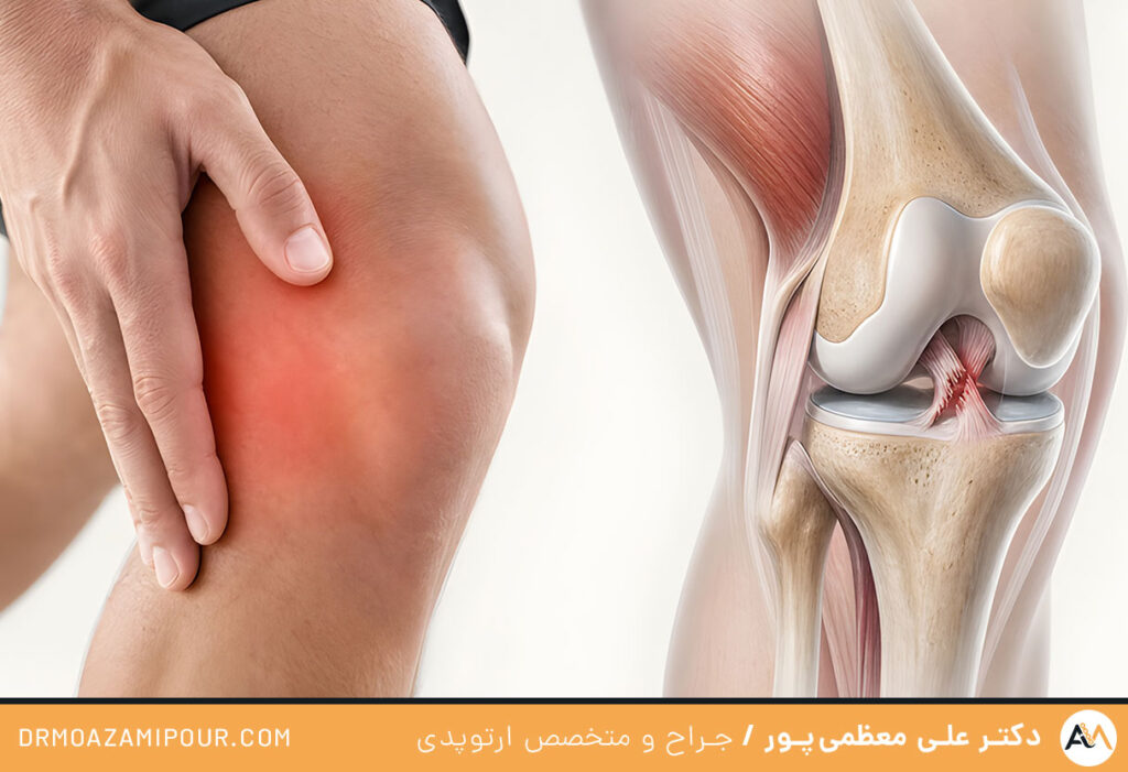 درمان کشیدگی رباط زانو