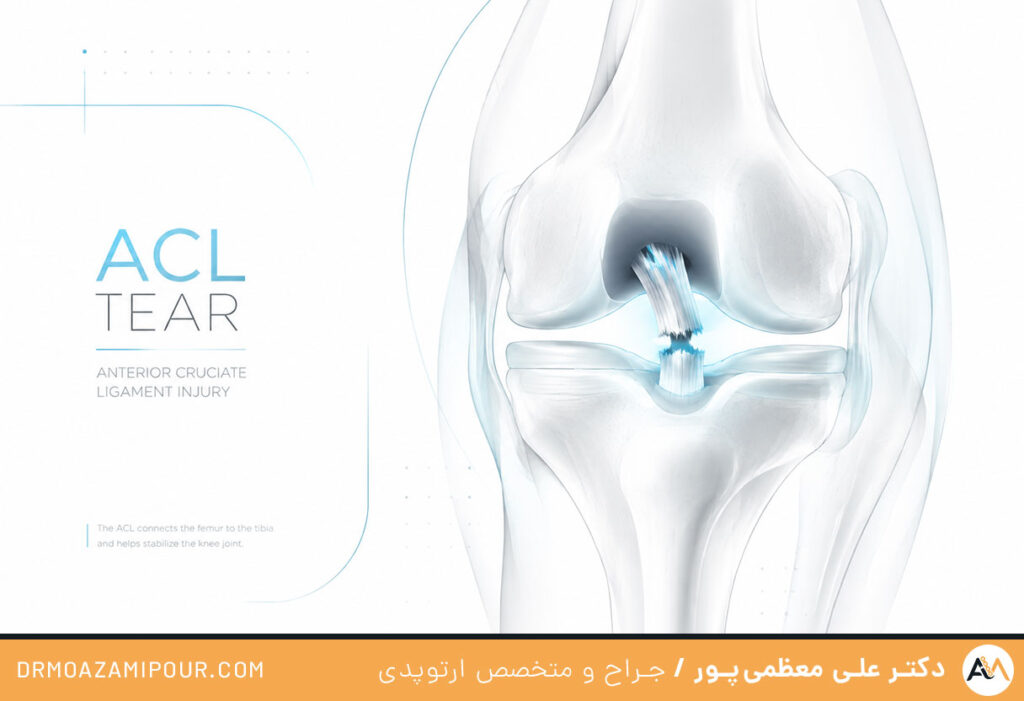 علائم پارگی رباط