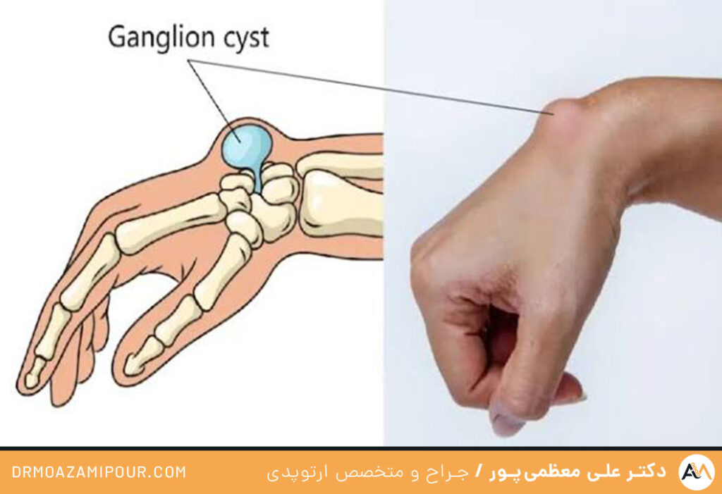 توده ژله ای مچ دست